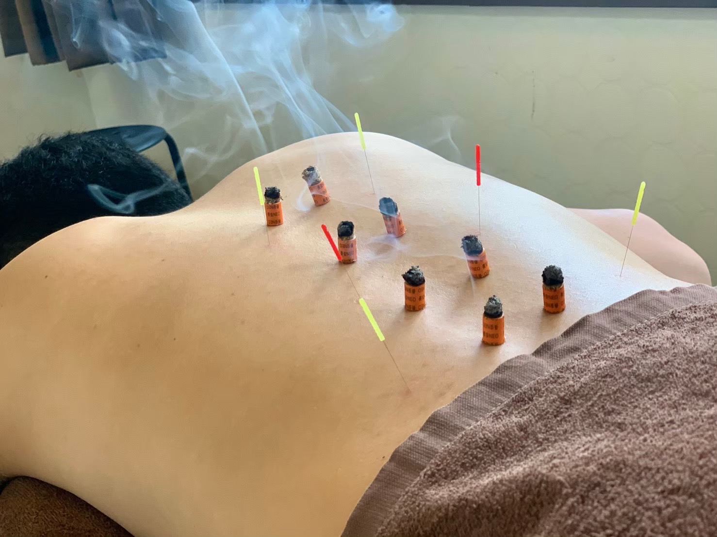 WHO(世界保健機関)が認めた鍼灸の適応症とは？ - 整骨院鍼灸院アシスト